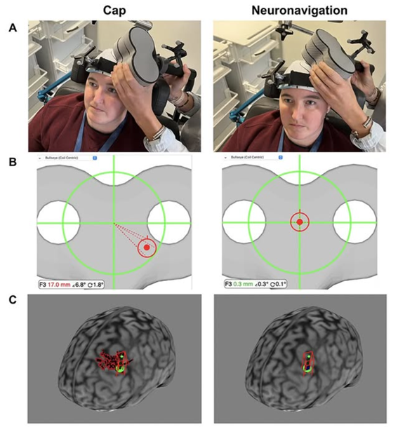 Neuronavigation for rTMS